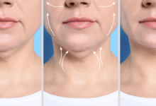 Fat Dissolving Injections